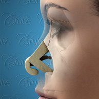 Septoplasty - nose surgery helps airway obstruction