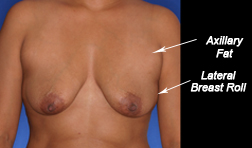Axillary fat and lateral breast roll