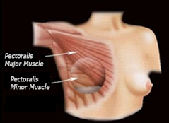 Inserting an implant under both pectoral muscles