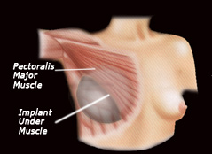 Breast implant under pectoralis major muscle