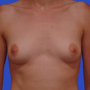 Before breast augmentation - frontal view