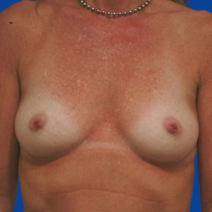 Before California natural breast lift - front view