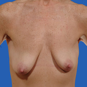 Asymmetrical breasts before lift and implants - front view