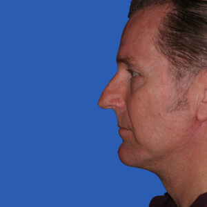 After chin implant - male - side view