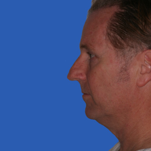 Before chin implant - male - side view