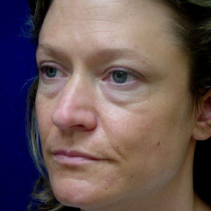 Before lower eyelid surgery - angle view