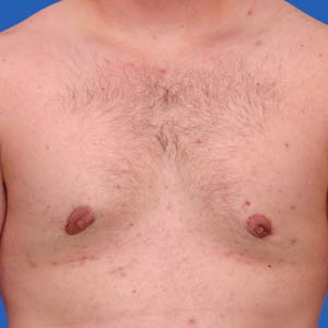 Excess fat and breast tissue gynecomastia after surgery - front view