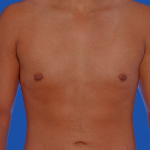 Excess fat gynecomastia after correction - front view