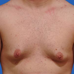 Excess fat and breast tissue gynecomastia before surgery - front view