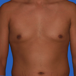 Excess fat gynecomastia before correction - front view