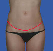 Standard abdominoplasty incision - front view