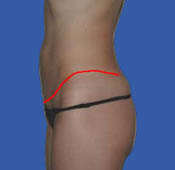 Extended abdominoplasty incision - side view