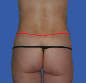 Circumfrential tummy tuck incision - rear view