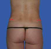 Extended abdominoplasty incision - rear view