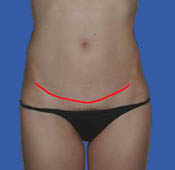 Mini tummy tuck incision - front view