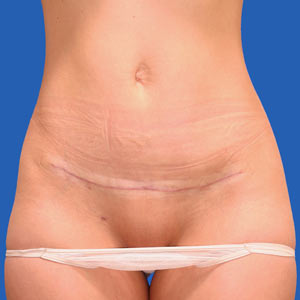 Incision from standard tummy tuck - front view
