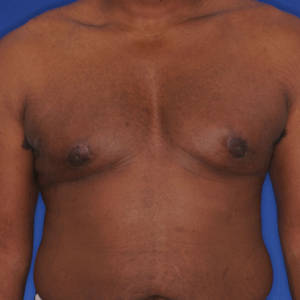 Excess fat, breast tissue, and skin gynecomastia after surgery - front view