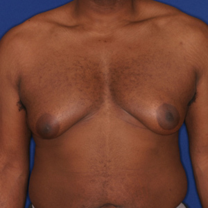 Excess fat, breast tissue, and skin gynecomastia before surgery - front view