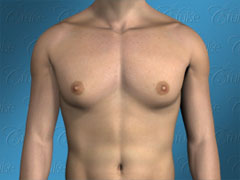 Male chest with classic gynecomastia