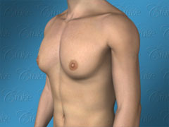 Classic gynecomastia image - male breast reduction available from top Newport Beach plastic surgeon
