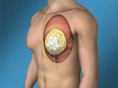 Diagram showing classic gynecomastia in male chest