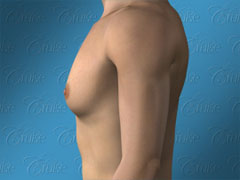 Male chest with classic gynecomastia - side view