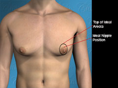 Diagram of nipple incision to correct mild saggy gynecomastia