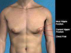 Diagram of nipple placement in mild saggy gynecomastia