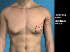 Incision around nipple to correct moderate saggy male breasts