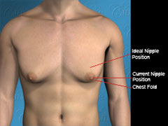 Diagram of nipple placement in moderate saggy gynecomastia
