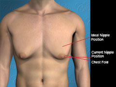 Diagram of nipple placement in severe saggy gynecomastia