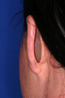 Diagram of area of ear excision in otoplasty