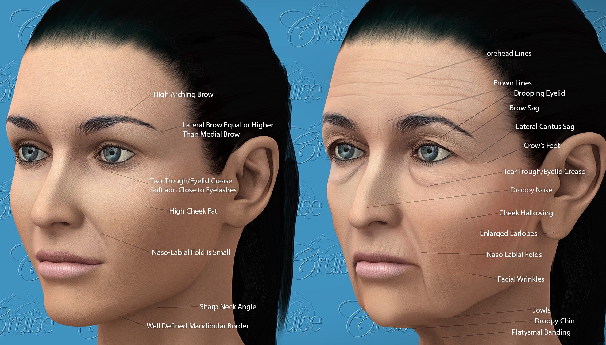 Breast implant placement comparisons: techniques illustrated.