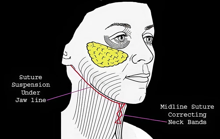 Breast types showing nipple positioning and relationship.