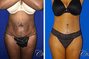 Tummy Tuck Pre-Op Instructions