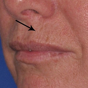 Wrinkles around your mouth?