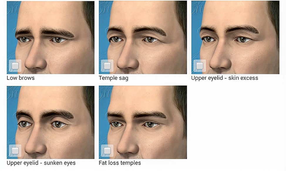 Facial features with aging effects illustrated.