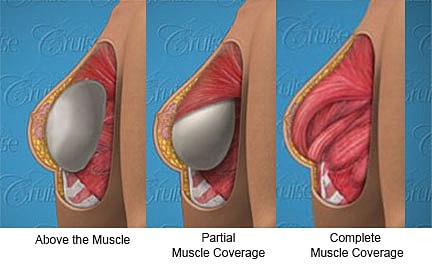 Breast implant placement comparisons: techniques illustrated.