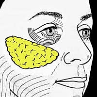 Illustration of facial anatomy and fat distribution.