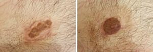 Skin lesions on human skin.
