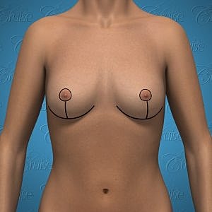 Anatomical illustration of female torso with markings.