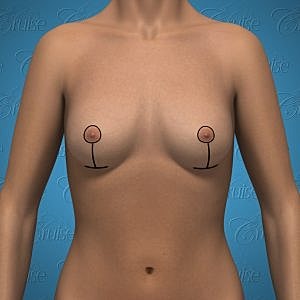 Anatomical illustration of female torso with markings.