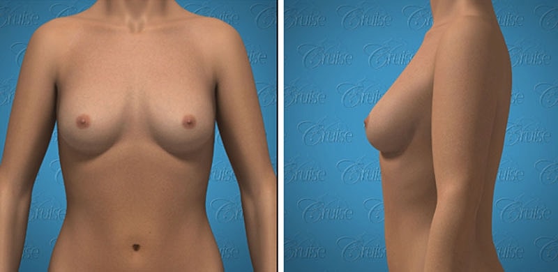 3D model of female torso from multiple angles.