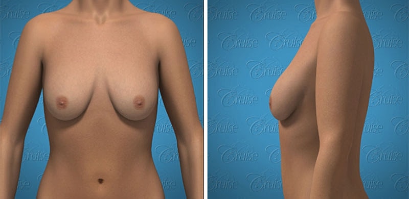 3D model of female torso from two angles