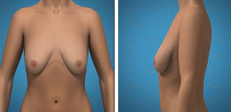 3D model of a female torso front and side.