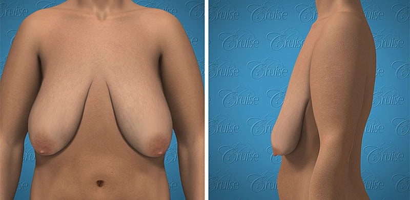 3D model of female torso, front and side views.