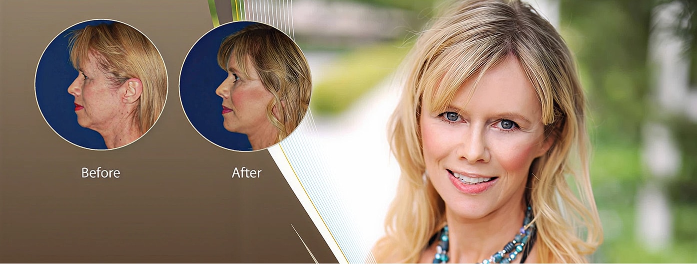 Before and after facial transformation results.