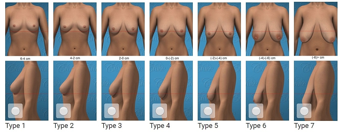 Breast types comparison with size variations.