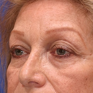 Close-up of aging woman's face, neutral expression.