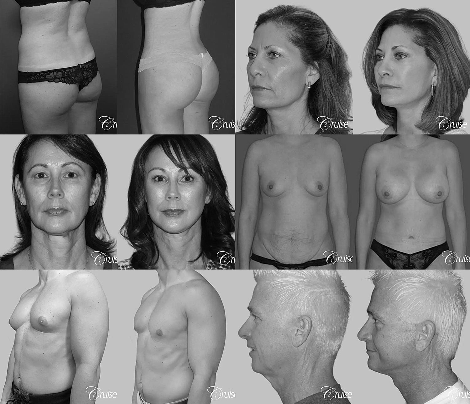 Before and after cosmetic surgery transformations.